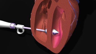 The non-invasive device, after being directed through a vein to the defect or hole in the heart, uses balloon technology to apply pressure and place the biodegradable patch over the defect. Then, as depicted in this digital rendering, UV light is emitted from the device and reflected inside the balloon, curing the patch. Afterwards, the device will be gently removed leaving the patch adhered in place.